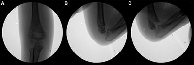 Minimally invasive surgical technique for unstable supracondylar humerus fractures in children (Gartland type III or IV)